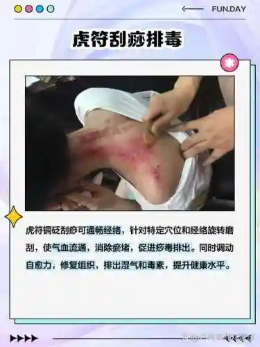 硬刮痧阵容